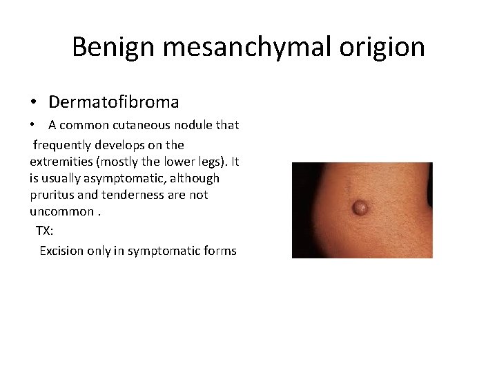 Benign mesanchymal origion • Dermatofibroma • A common cutaneous nodule that frequently develops on