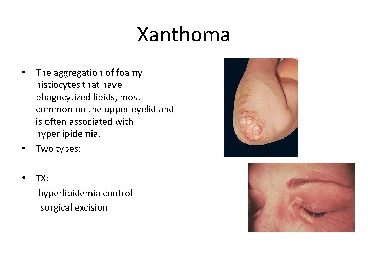 Xanthoma • The aggregation of foamy histiocytes that have phagocytized lipids, most common on