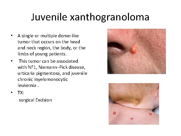 Juvenile xanthogranoloma • A single or multiple dome-like tumor that occurs on the head