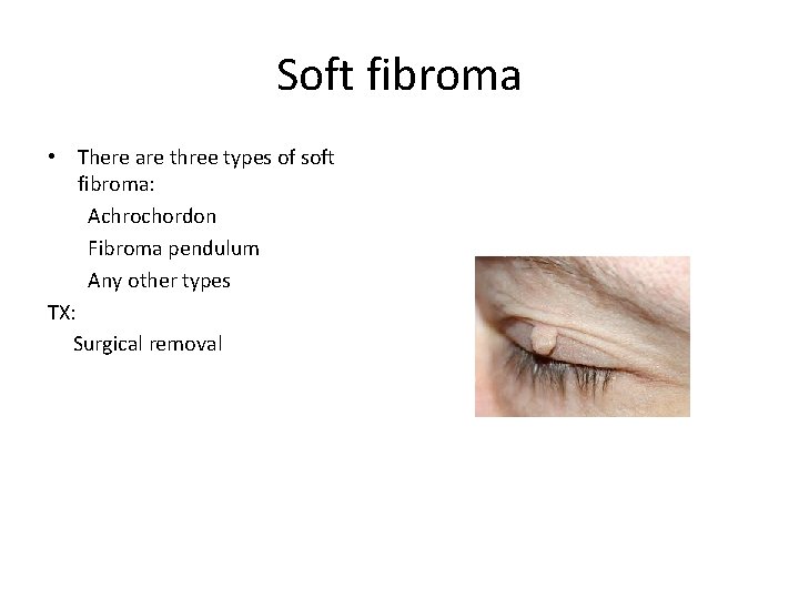 Soft fibroma • There are three types of soft fibroma: Achrochordon Fibroma pendulum Any