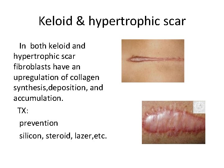 Keloid & hypertrophic scar In both keloid and hypertrophic scar fibroblasts have an upregulation