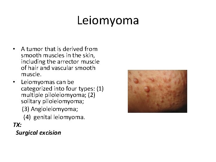 Leiomyoma • A tumor that is derived from smooth muscles in the skin, including