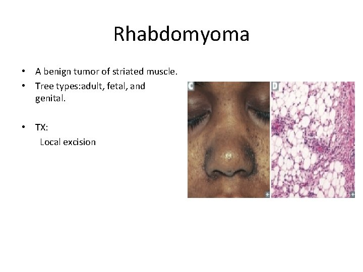 Rhabdomyoma • A benign tumor of striated muscle. • Tree types: adult, fetal, and