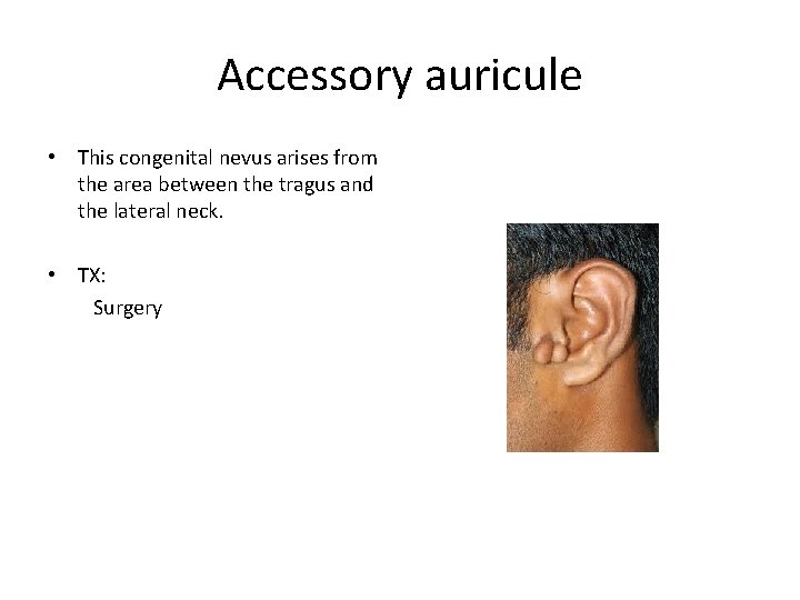 Accessory auricule • This congenital nevus arises from the area between the tragus and