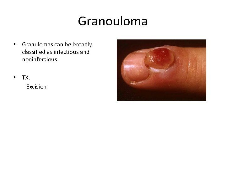 Granouloma • Granulomas can be broadly classified as infectious and noninfectious. • TX: Excision