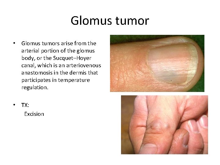 Glomus tumor • Glomus tumors arise from the arterial portion of the glomus body,