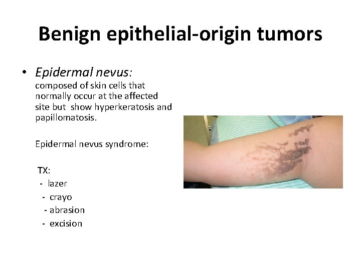 Benign epithelial-origin tumors • Epidermal nevus: composed of skin cells that normally occur at