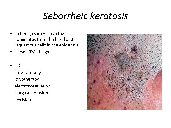 Seborrheic keratosis • a benign skin growth that originates from the basal and squamous
