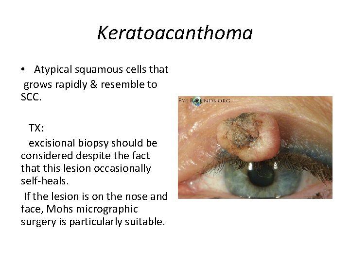 Keratoacanthoma • Atypical squamous cells that grows rapidly & resemble to SCC. TX: excisional