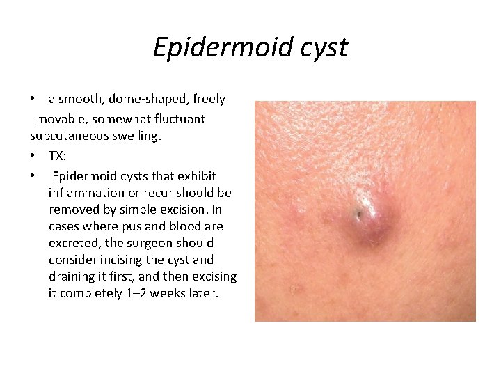 Epidermoid cyst • a smooth, dome-shaped, freely movable, somewhat fluctuant subcutaneous swelling. • TX: