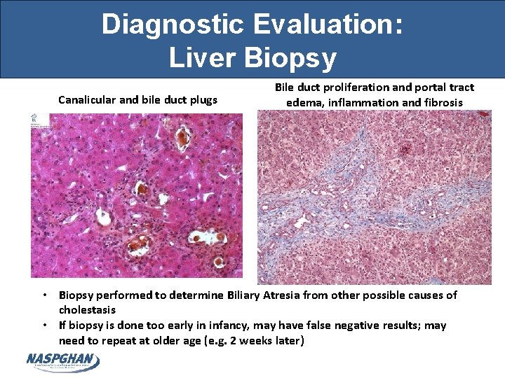 Diagnostic Evaluation: Liver Biopsy Canalicular and bile duct plugs Bile duct proliferation and portal