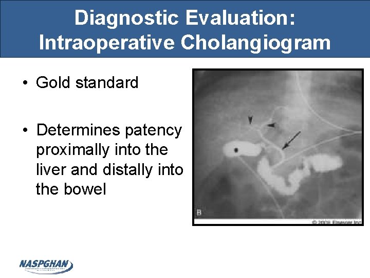 Diagnostic Evaluation: Intraoperative Cholangiogram • Gold standard • Determines patency proximally into the liver