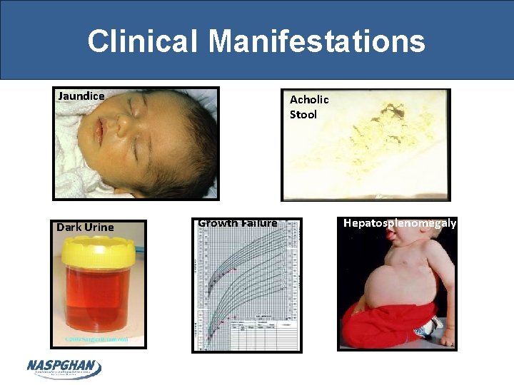 Clinical Manifestations Jaundice Dark Urine Acholic Stool Growth Failure Hepatosplenomegaly 