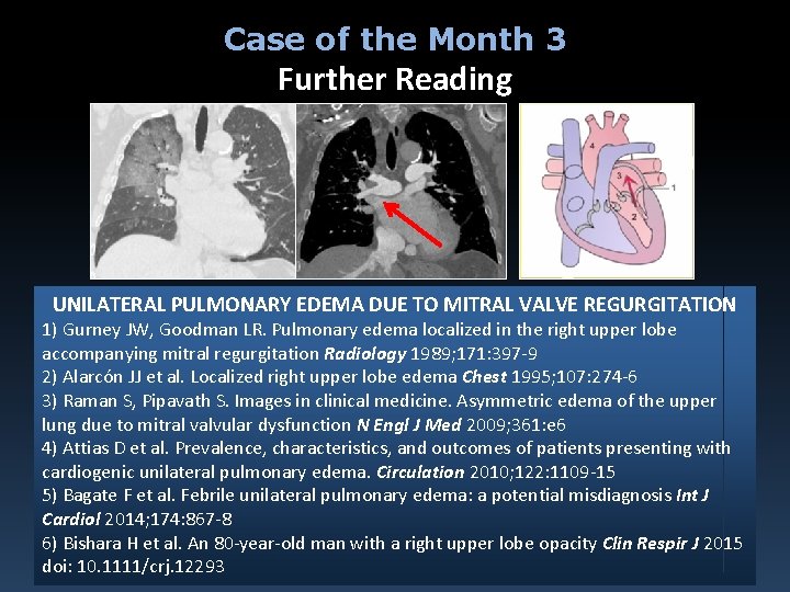 Case of the Month 3 Further Reading UNILATERAL PULMONARY EDEMA DUE TO MITRAL VALVE
