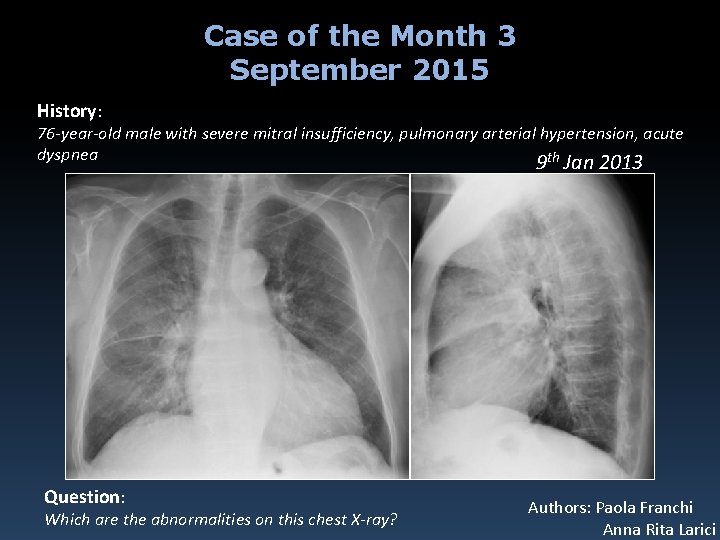 Case of the Month 3 September 2015 History: 76 -year-old male with severe mitral