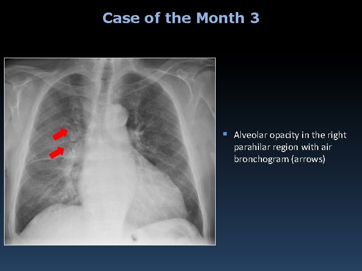 Case of the Month 3 § Alveolar opacity in the right parahilar region with
