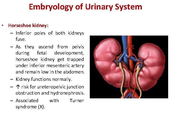Embryology of Urinary System • Horseshoe kidney: – Inferior poles of both kidneys fuse.
