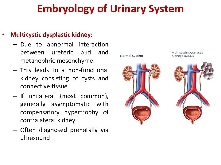 Embryology of Urinary System • Multicystic dysplastic kidney: – Due to abnormal interaction between