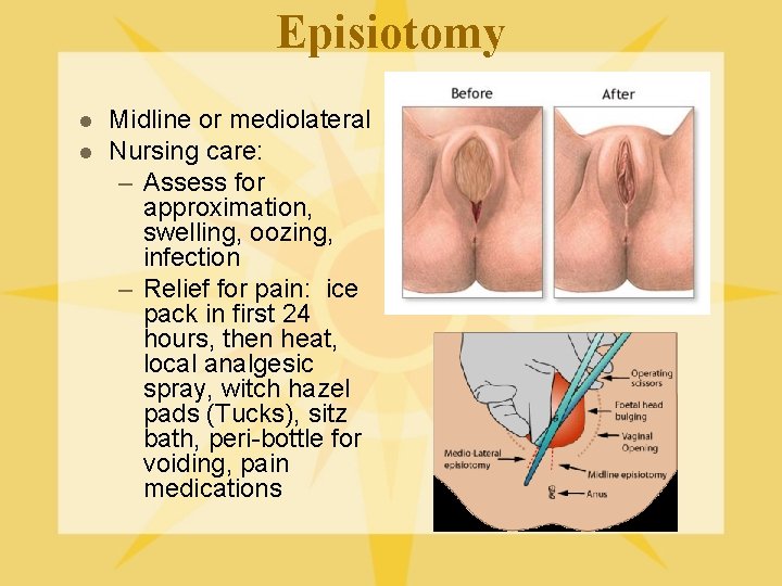 Episiotomy l l Midline or mediolateral Nursing care: – Assess for approximation, swelling, oozing,
