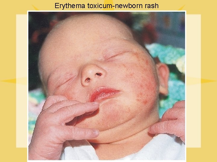 Erythema toxicum-newborn rash 