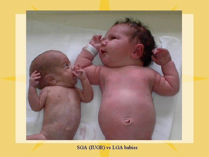 SGA (IUGR) vs LGA babies 