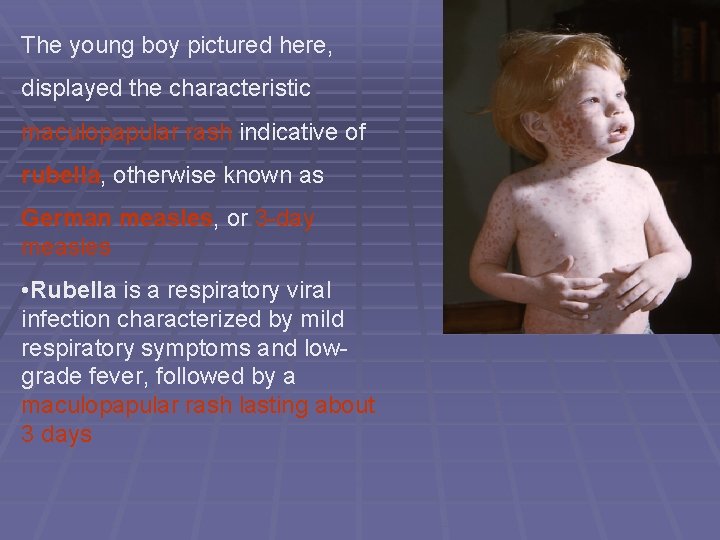 The young boy pictured here, displayed the characteristic maculopapular rash indicative of rubella, otherwise