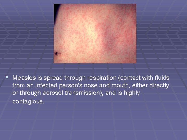 § Measles is spread through respiration (contact with fluids from an infected person's nose