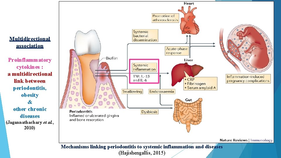 Multidirectional association Proinflammatory cytokines : a multidirectional link between periodontitis, obesity & other chronic