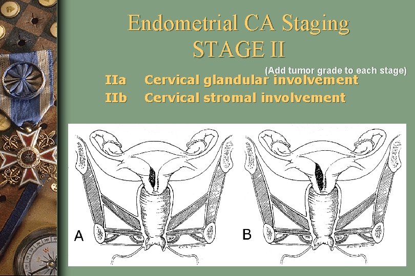 Endometrial CA Staging STAGE II IIa IIb (Add tumor grade to each stage) Cervical