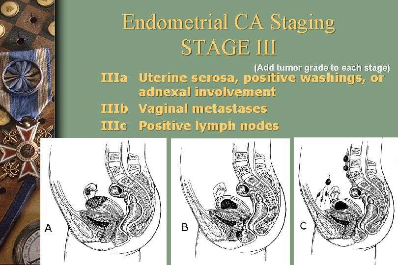 Endometrial CA Staging STAGE III (Add tumor grade to each stage) IIIa Uterine serosa,