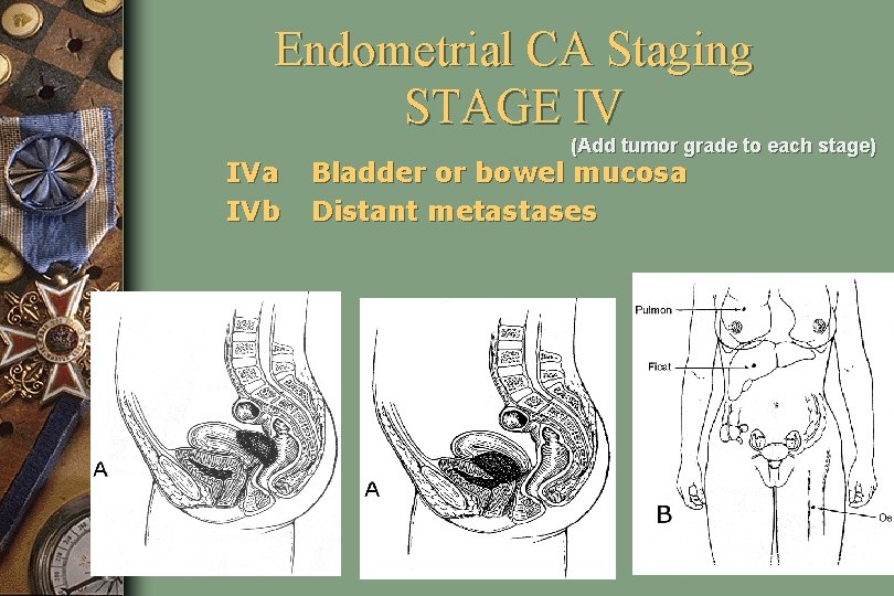 Endometrial CA Staging STAGE IV IVa IVb (Add tumor grade to each stage) Bladder