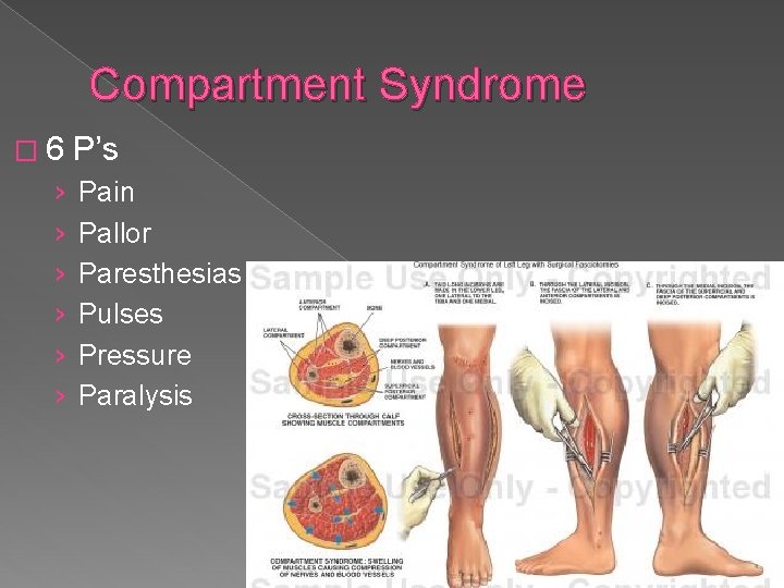 Compartment Syndrome � 6 › › › P’s Pain Pallor Paresthesias Pulses Pressure Paralysis