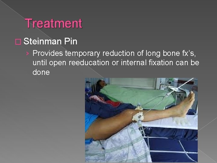 Treatment � Steinman Pin › Provides temporary reduction of long bone fx’s, until open