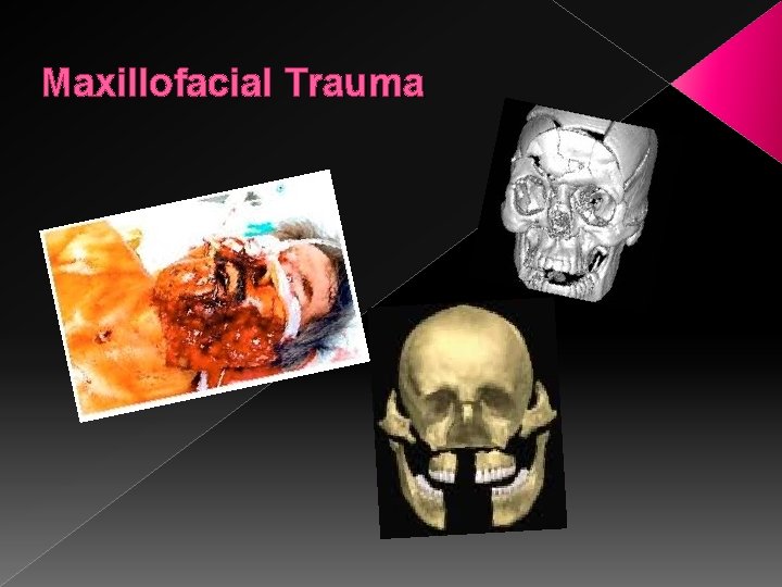 Maxillofacial Trauma 