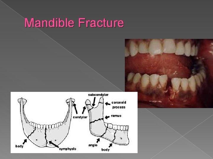 Mandible Fracture 