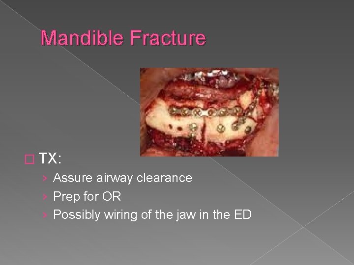 Mandible Fracture � TX: › Assure airway clearance › Prep for OR › Possibly