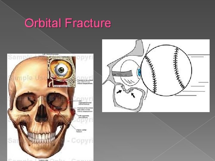 Orbital Fracture 