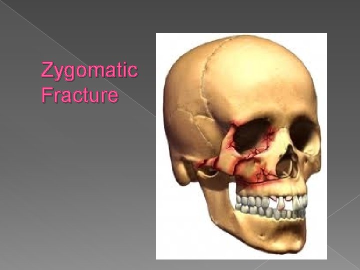 Zygomatic Fracture 