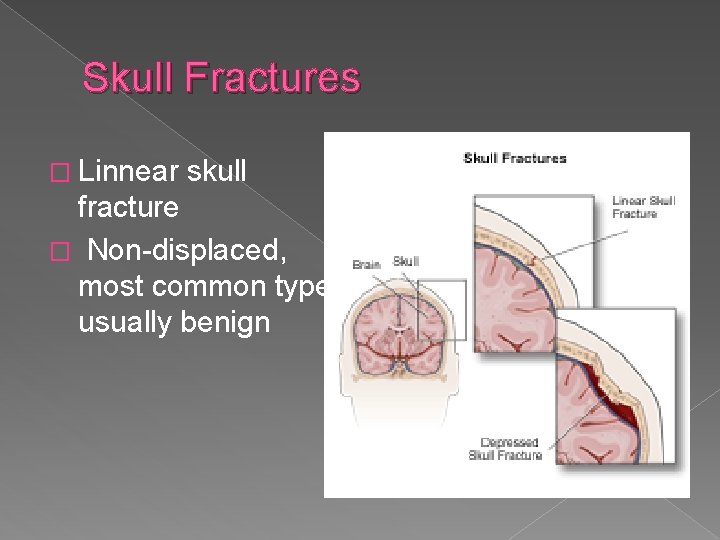 Skull Fractures � Linnear skull fracture � Non-displaced, most common type, usually benign 