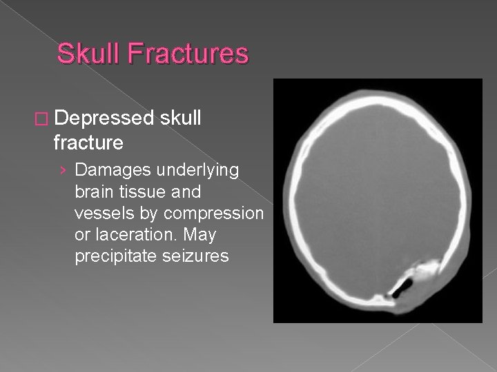 Skull Fractures � Depressed skull fracture › Damages underlying brain tissue and vessels by