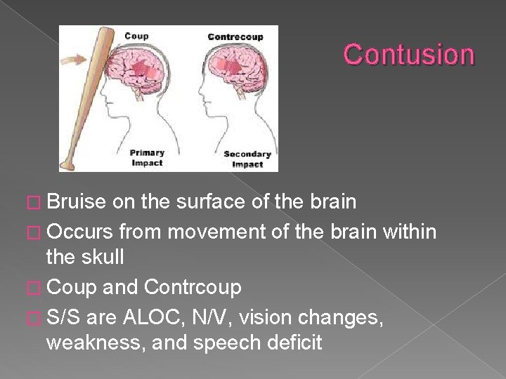 Contusion � Bruise on the surface of the brain � Occurs from movement of