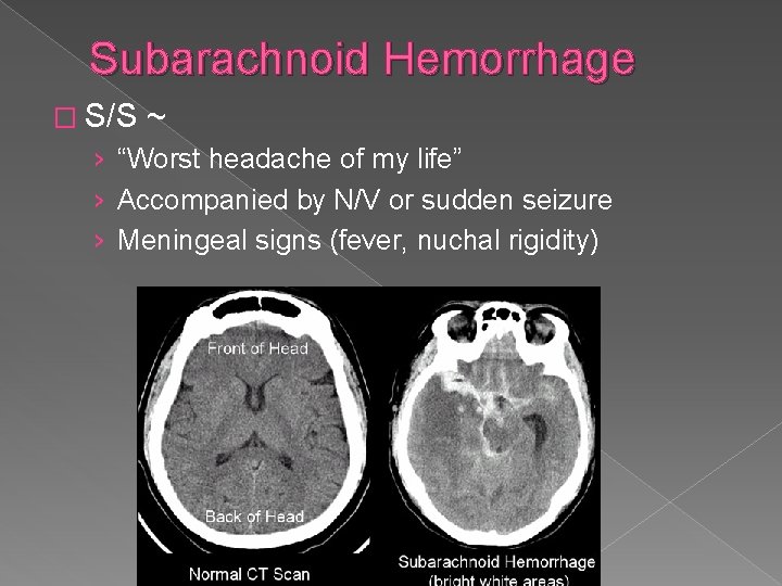 Subarachnoid Hemorrhage � S/S ~ › “Worst headache of my life” › Accompanied by