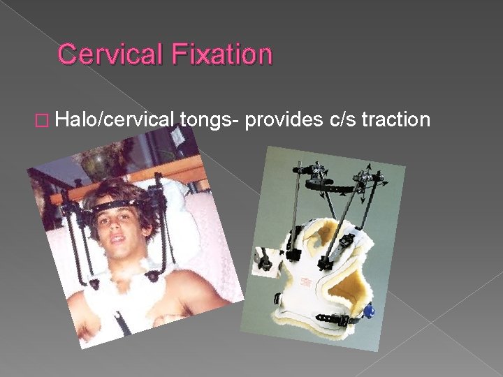 Cervical Fixation � Halo/cervical tongs- provides c/s traction 
