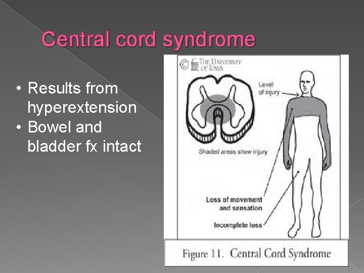 Central cord syndrome • Results from hyperextension • Bowel and bladder fx intact 
