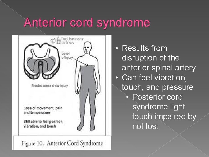 Anterior cord syndrome • Results from disruption of the anterior spinal artery • Can