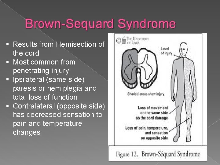Brown-Sequard Syndrome § Results from Hemisection of the cord § Most common from penetrating