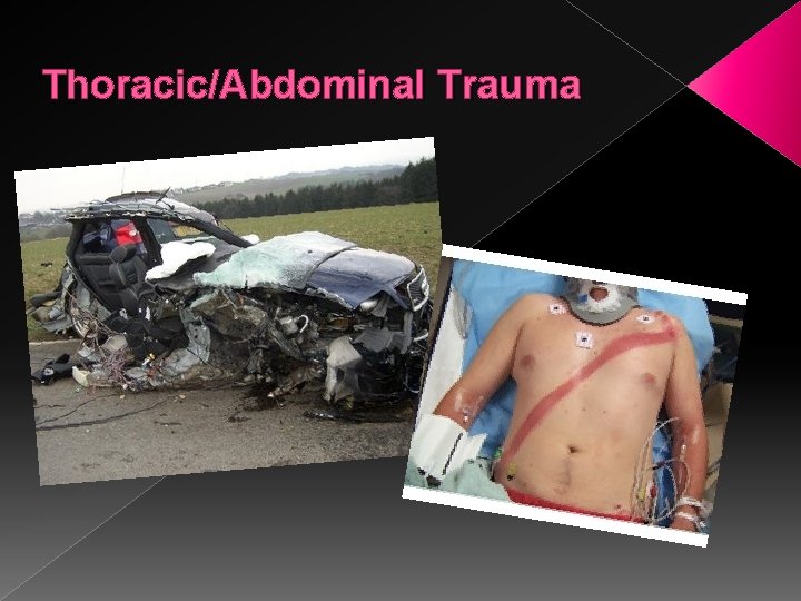 Thoracic/Abdominal Trauma 