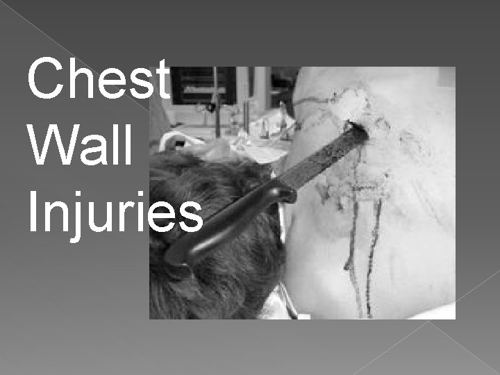 Chest Wall Injuries 