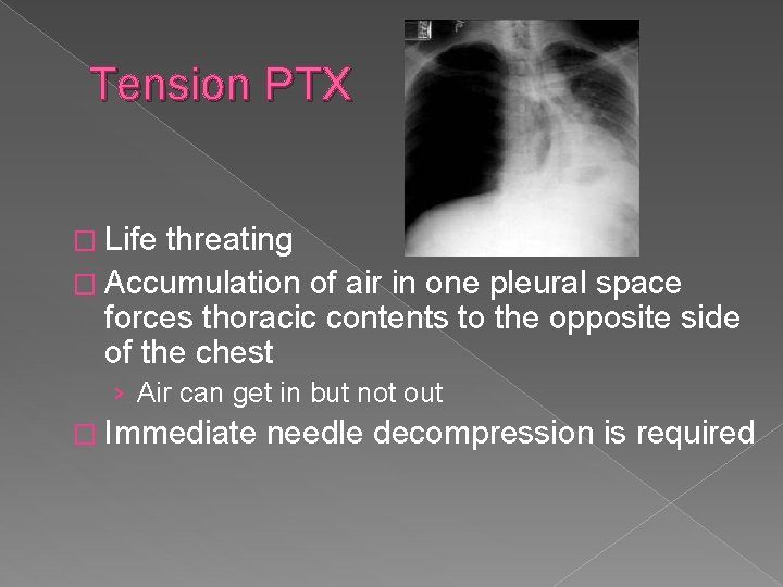 Tension PTX � Life threating � Accumulation of air in one pleural space forces