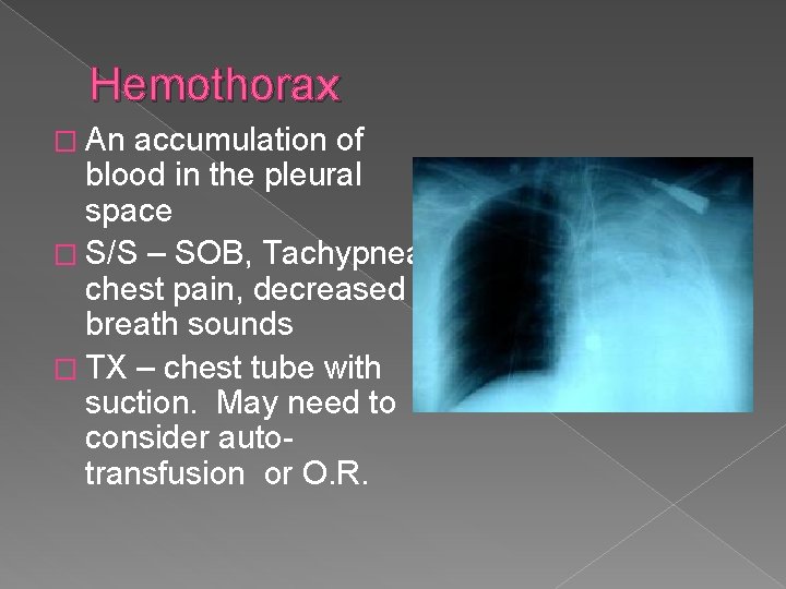 Hemothorax � An accumulation of blood in the pleural space � S/S – SOB,